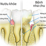 Chuyên gia Cao đẳng Điều dưỡng Sài Gòn chia sẻ về bệnh nha chu