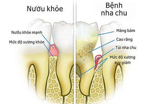 Có nhiều nguyên nhân gây bệnh nha chu, nhưng về cơ bản gồm nguyên nhân tại chỗ và nguyên nhân toàn thân Có nhiều nguyên nhân gây bệnh nha chu, nhưng về cơ bản gồm nguyên nhân tại chỗ và nguyên nhân toàn thân