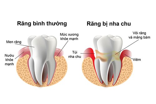 Những bệnh nha chu phổ biến nhất: viêm nướu, viêm nha chu phá hủy, suy nha chu Những bệnh nha chu phổ biến nhất: viêm nướu, viêm nha chu phá hủy, suy nha chu