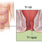 Chuyên gia Cao đẳng Điều dưỡng Sài Gòn chia sẻ về bệnh Trĩ
