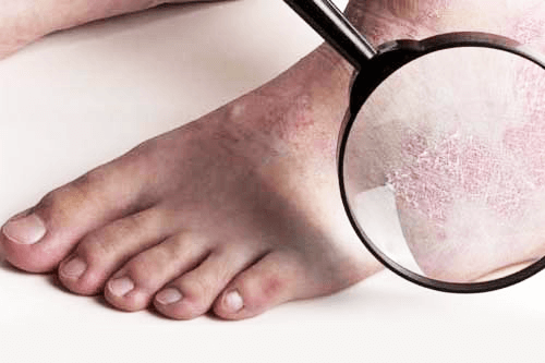 Nguyên tắc điều trị bệnh vẩy nến chủ yếu điều trị triệu chứng và điều trị lâu dài Nguyên tắc điều trị bệnh vẩy nến chủ yếu điều trị triệu chứng và điều trị lâu dài