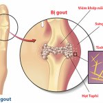 Điều dưỡng Sài Gòn tư vấn cách điều trị bệnh Gout