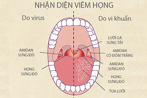 Cách nhận diện bệnh viêm họng chính xác nhất Cách nhận diện bệnh viêm họng chính xác nhất