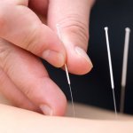 Bác sĩ y học cổ truyền bật mí lợi ích của việc châm cứu bấm huyệt trị bệnh
