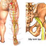 Điều trị đau thần kinh tọa hợp lí cùng chuyên gia Điều dưỡng Sài Gòn