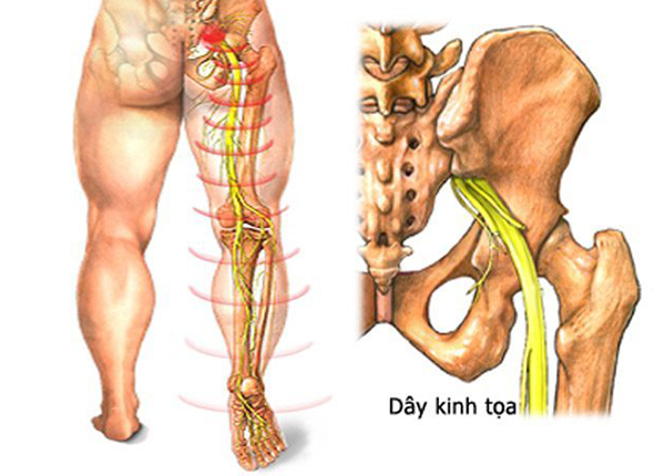 Điều trị đau thần kinh tọa hợp lí cùng chuyên gia Điều dưỡng Sài Gòn Điều trị đau thần kinh tọa hợp lí cùng chuyên gia Điều dưỡng Sài Gòn