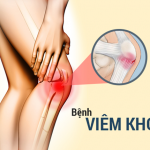 Tìm hiểu bài thuốc Đông Y chữa bệnh viêm khớp từ Y sĩ YHCT Sài Gòn