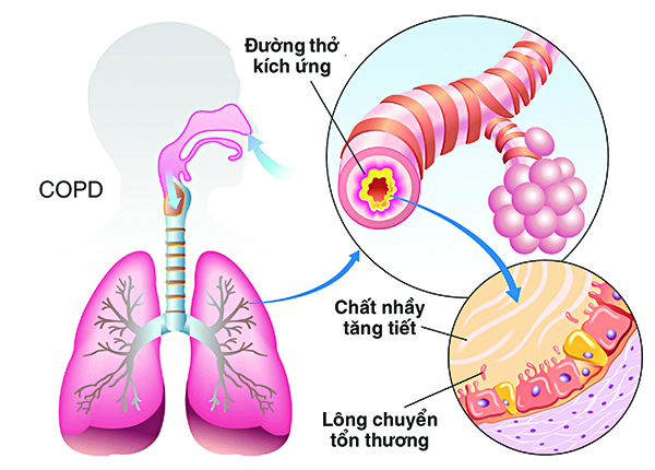 Tìm hiểu bệnh phổi tắc nghẽn mãn tính cùng chuyên gia Điều dưỡng SG Tìm hiểu bệnh phổi tắc nghẽn mãn tính cùng chuyên gia Điều dưỡng SG