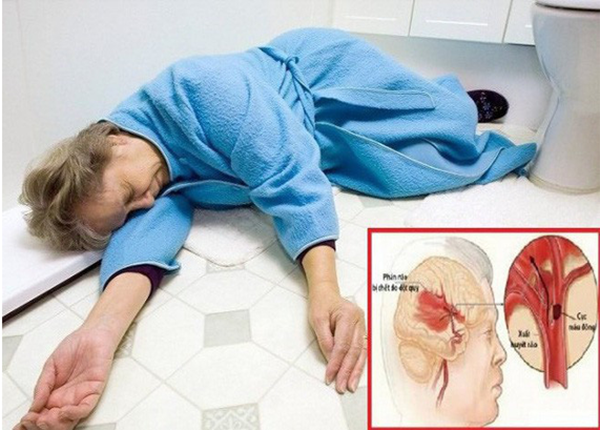 Tìm hiểu biện pháp phòng ngừa đột quỵ cùng Điều dưỡng Sài Gòn Tìm hiểu biện pháp phòng ngừa đột quỵ cùng Điều dưỡng Sài Gòn