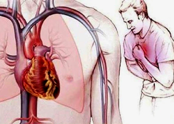 Tìm hiểu về chứng đau thắt ngực từ chuyên gia Điều dưỡng Sài Gòn Tìm hiểu về chứng đau thắt ngực từ chuyên gia Điều dưỡng Sài Gòn