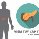 Tìm hiểu về Viêm tụy cấp cùng chuyên gia Điều dưỡng Sài Gòn