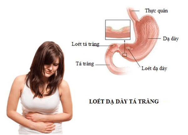 Trị bệnh Viêm loét dạ dày tá tràng như thế nào