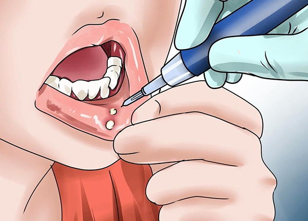 Giảng viên Trường Dược Sài Gòn tư vấn cách điều trị bệnh Nhiệt miệng Giảng viên Trường Dược Sài Gòn tư vấn cách điều trị bệnh Nhiệt miệng