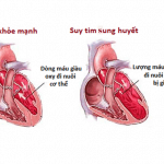 Tìm hiểu bệnh Suy tim sung huyết cùng chuyên gia Điều dưỡng Sài Gòn