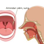 Tìm hiểu biện pháp trị Viêm Amidan từ giảng viên trường Dược Sài Gòn