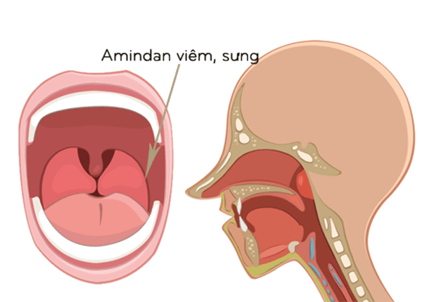 Tìm hiểu biện pháp trị Viêm Amidan từ giảng viên trường Dược Sài Gòn Tìm hiểu biện pháp trị Viêm Amidan từ giảng viên trường Dược Sài Gòn