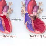 Tìm hiểu căn bệnh nguy hiểm Suy tim từ chuyên gia Điều dưỡng Sài Gòn