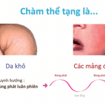 Tìm hiểu về bệnh Chàm thể tạng cùng chuyên gia Điều dưỡng Sài Gòn