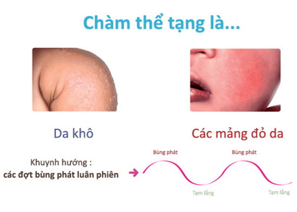 Tìm hiểu về bệnh Chàm thể tạng cùng chuyên gia Điều dưỡng Sài Gòn Tìm hiểu về bệnh Chàm thể tạng cùng chuyên gia Điều dưỡng Sài Gòn