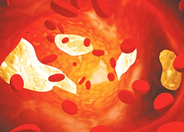 Tìm hiểu về bệnh Lipid huyết cùng chuyên gia Trường Dược Sài Gòn Tìm hiểu về bệnh Lipid huyết cùng chuyên gia Trường Dược Sài Gòn