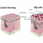 Tìm hiểu về bệnh Vảy nến cùng chuyên gia Điều dưỡng Sài Gòn