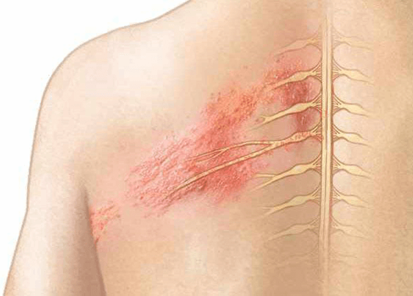Tìm hiểu về bệnh Zona thần kinh cùng chuyên gia Điều dưỡng Sài Gòn Tìm hiểu về bệnh Zona thần kinh cùng chuyên gia Điều dưỡng Sài Gòn