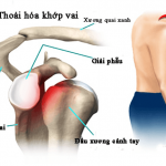Chuyên gia Dược Sài Gòn chia sẻ các triệu chứng thoái hóa khớp vai