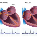 Tìm hiểu về bệnh Rung nhĩ từ chuyên gia Trường Dược Sài Gòn