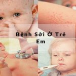 Chuyên gia Trường Dược Sài Gòn nói về biến chứng của bệnh Sởi