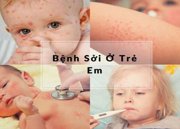 Chuyên gia Trường Dược Sài Gòn nói về biến chứng của bệnh Sởi Chuyên gia Trường Dược Sài Gòn nói về biến chứng của bệnh Sởi