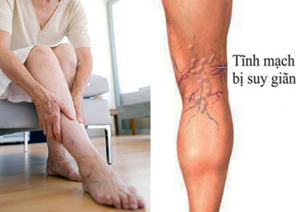 Bệnh giãn tĩnh mạch là tình trạng tĩnh mạch bị phình to ra Bệnh giãn tĩnh mạch là tình trạng tĩnh mạch bị phình to ra