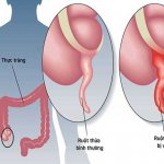 Tìm hiểu dấu hiệu lâm sàng của viêm ruột thừa cùng Điều dưỡng Sài Gòn