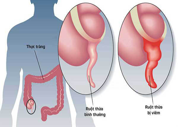 Viêm ruột thừa là tình trạng ruột thừa bị viêm nhiễm Viêm ruột thừa là tình trạng ruột thừa bị viêm nhiễm