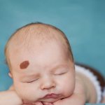 Cùng chuyên gia Dược Sài Gòn tìm hiểu về bệnh U máu ở trẻ em