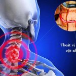 Nguyên nhân và dấu hiệu nhận biết bệnh thoát vị đĩa đệm cột sống cổ