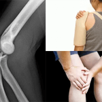 Những điều bạn cần phải nắm rõ nếu mắc bệnh trật khớp