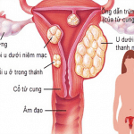 Bệnh u xơ tử cung có thực sự quá đáng sợ như bạn nghĩ?