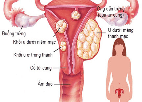 Bệnh u xơ tử cung là bệnh lý phụ khoa phổ biến ở mọi độ tuổi của phụ nữ Bệnh u xơ tử cung là bệnh lý phụ khoa phổ biến ở mọi độ tuổi của phụ nữ