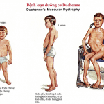 Chia sẻ về bệnh loạn dưỡng cơ Duchenne từ Bs Trường Dược Sài Gòn