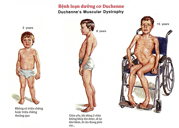 Loạn dưỡng cơ Duchenne là một trong những bệnh làm cho cơ bắp yếu hơn Loạn dưỡng cơ Duchenne là một trong những bệnh làm cho cơ bắp yếu hơn