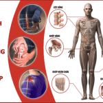 Lời khuyên giúp phòng tránh bệnh xương khớp từ Bs Trường Dược Sài Gòn