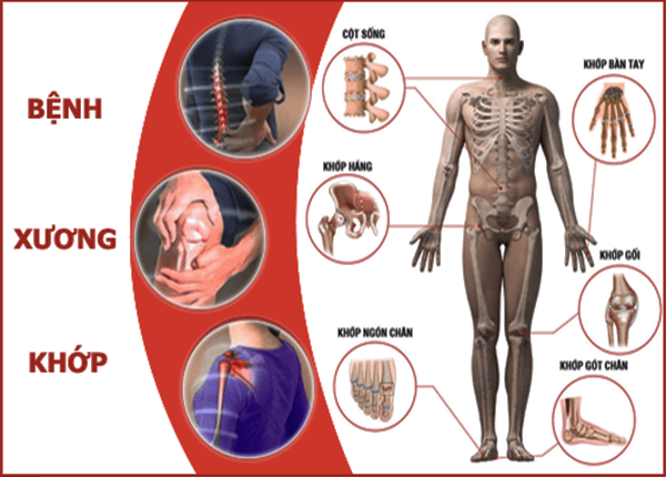 Lời khuyên giúp phòng tránh bệnh xương khớp từ Bs Trường Dược Sài Gòn Lời khuyên giúp phòng tránh bệnh xương khớp từ Bs Trường Dược Sài Gòn