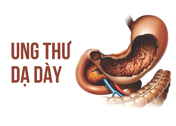 Ung thư dạ dày là căn bệnh phổ biến thứ 3 trong các bệnh ung thư Ung thư dạ dày là căn bệnh phổ biến thứ 3 trong các bệnh ung thư