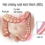 Những thông tin bạn cần biết về hội chứng ruột kích thích