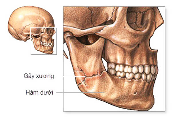 Hình ảnh gãy xương hàm dưới Hình ảnh gãy xương hàm dưới