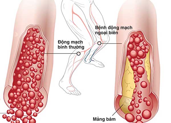 Bệnh xơ vữa động mạch ngoại biên Bệnh xơ vữa động mạch ngoại biên