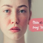 Da mặt bị dị ứng và những cách xử lý đơn giản tại nhà
