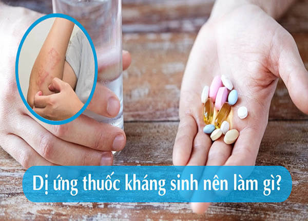 Dị ứng thuốc kháng sinh Dị ứng thuốc kháng sinh