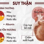 Nguyên nhân triệu chứng và biện pháp điều trị bệnh suy thận