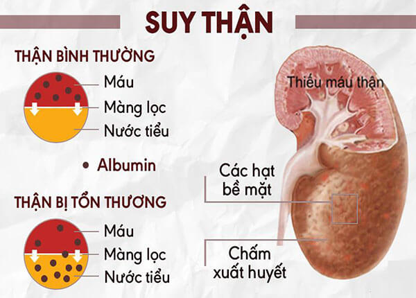 Bệnh suy thận Bệnh suy thận